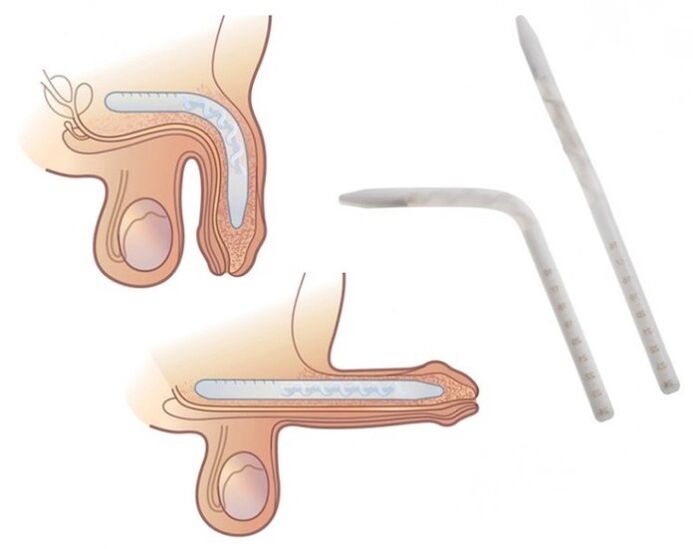 Falloplastie pour augmenter un membre