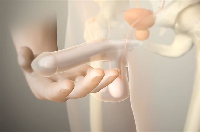 Implants gel pour augmenter un membre