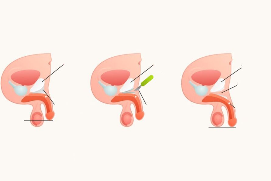 Ligamentotomie pour augmenter le pénis