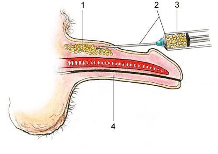 Lipofilant pour augmenter un membre
