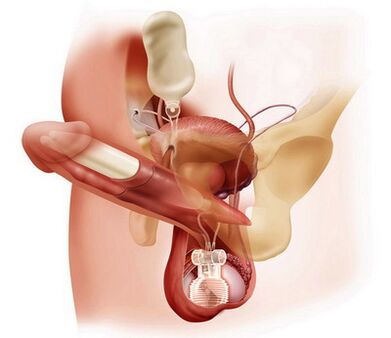 agrandissement chirurgical du pénis